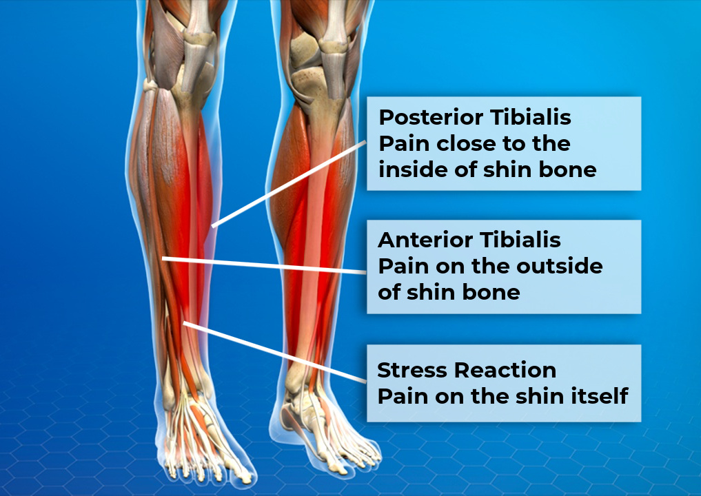 Shin Splints in Runners