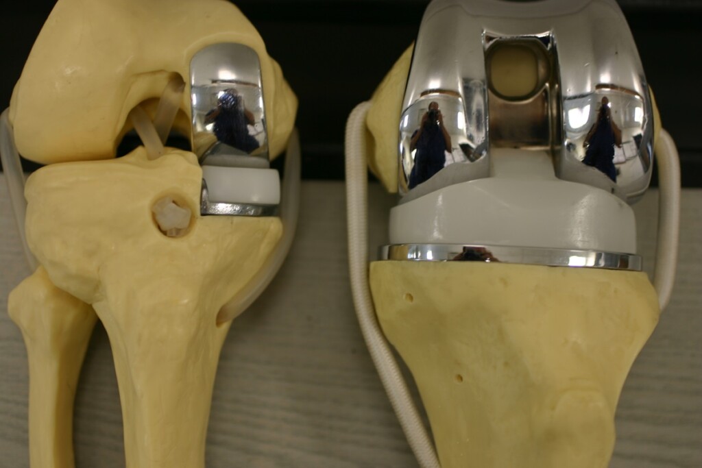 running after partial knee replacement