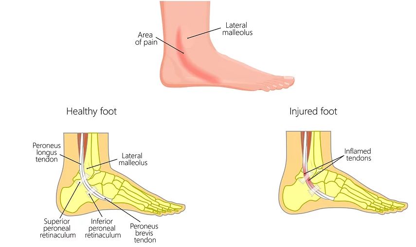 Peroneal Tendonitis in Runners