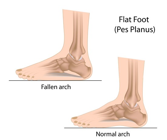 Running with Flat Feet