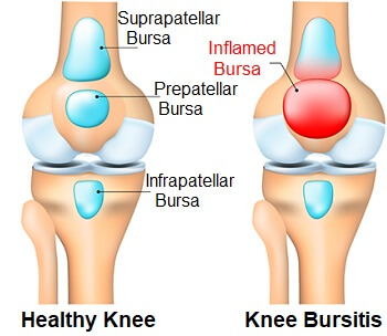 knee pain causes