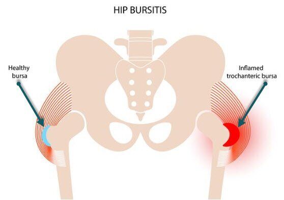 hip bursitis running